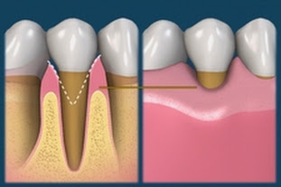 Чем опасен клиновидный дефект зубов