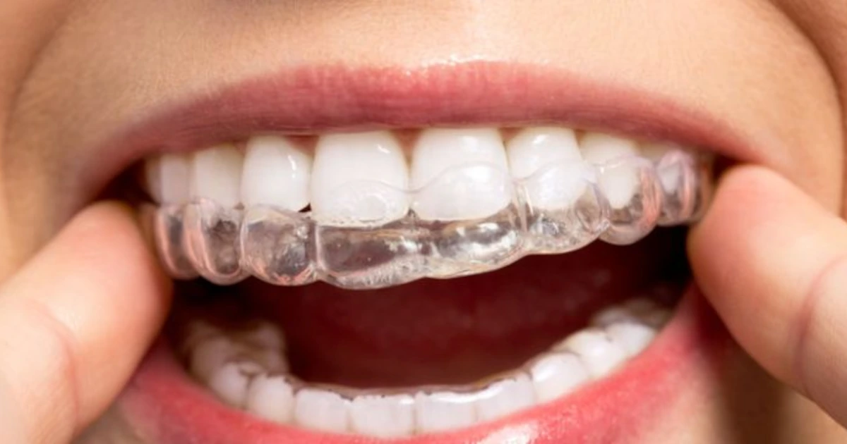 Ортодонтические элайнеры: идеальный путь к исправлению улыбки