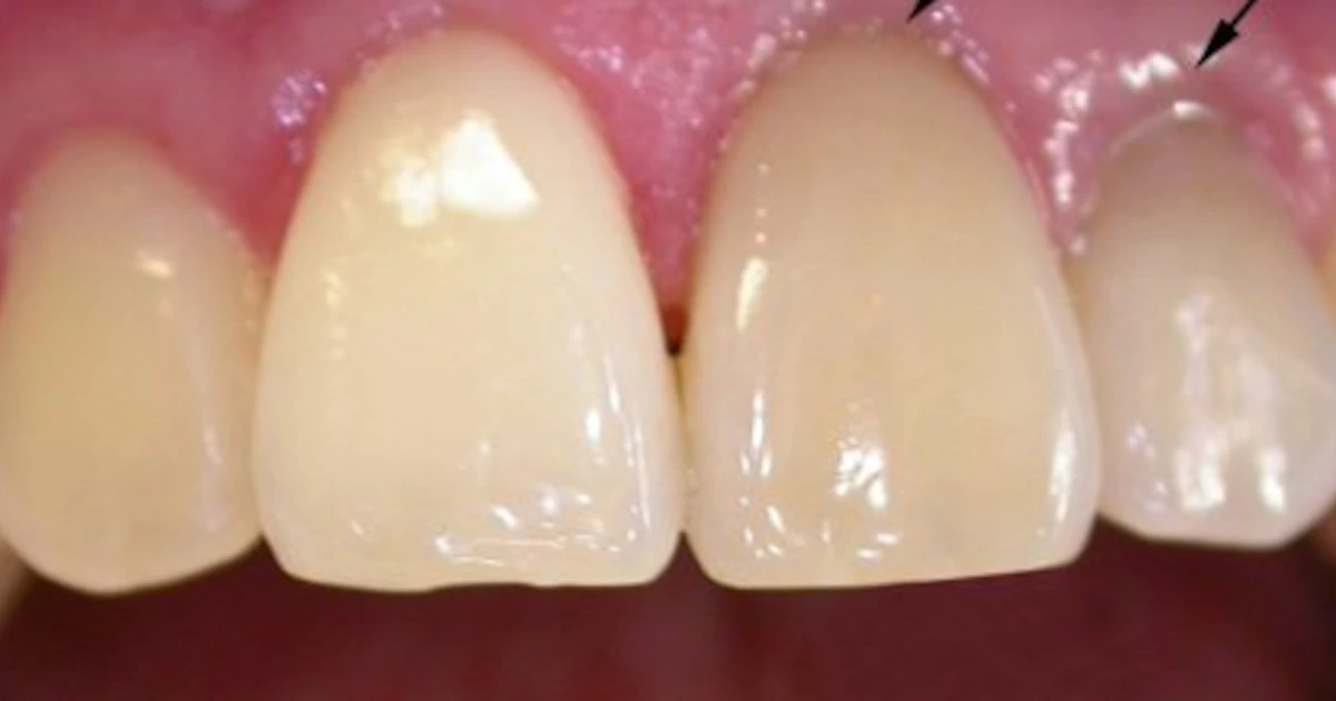 Протезирование передних зубов: тотально или пошагово? Как сделать лучший выбор